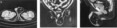 Case Report: Giant paratesticular liposarcoma was resected and refused radical orchiectomy